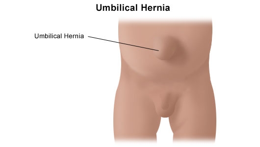 Hernia ombilicala